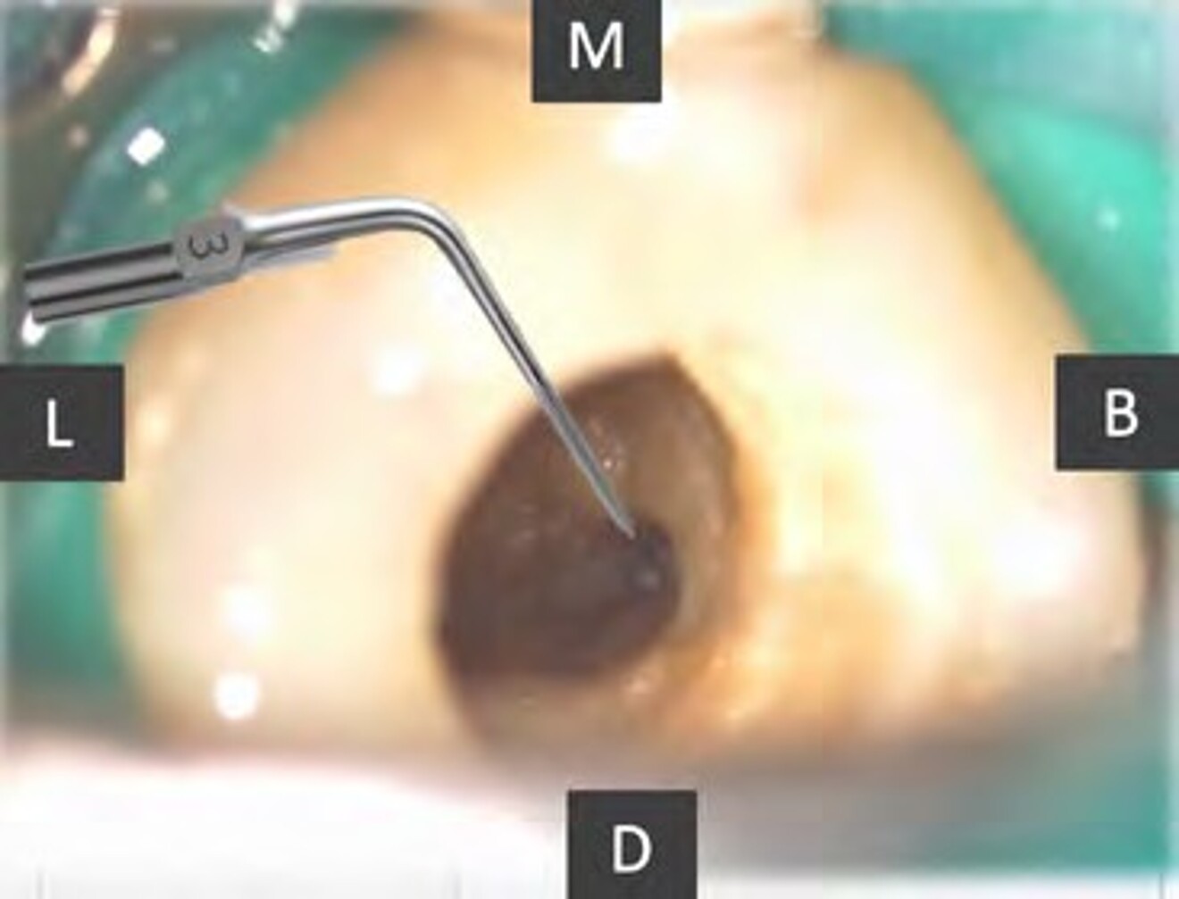 Fig. 1b: Straight-line access established under the dental operating microscope, with the coronal portion of  the separated instrument exposed after removal of the dentinal triangle using the START-X #3 ultrasonic tip.