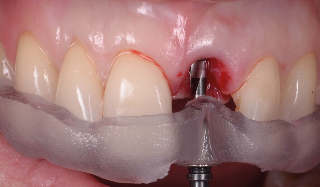 Fig. 11b : Position de forage optimisée du premier foret. La partie interne contient un manchon de forage en titane (a), pour assurer la précision de l’angulation et du niveau de butée (b). 