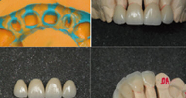 Coronas estéticas anteriores. Caso clínico