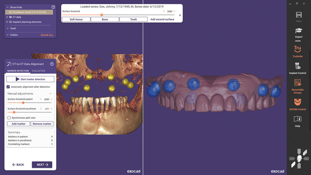 Exocad releases exoplan 3.0 Galway software in the US
