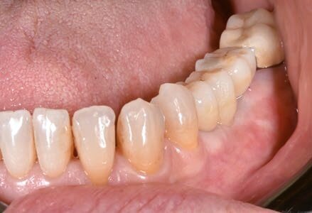 Fig. 18 - Visione vestibolare del manufatto protesico e della rigenerazione vestibolare fatta a fini estetici.