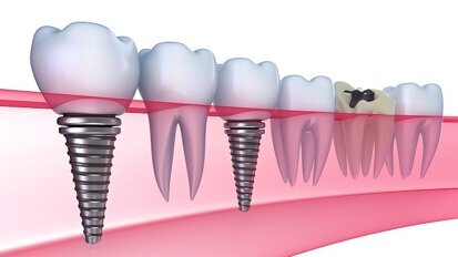 KiMo stelt eerste klinische richtlijn vast: peri-implantaire infecties