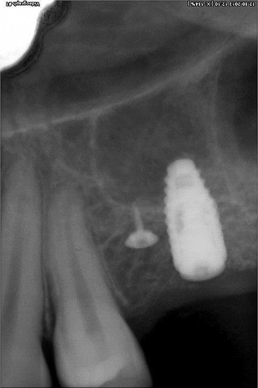 Fig. 20: Integrated implant.