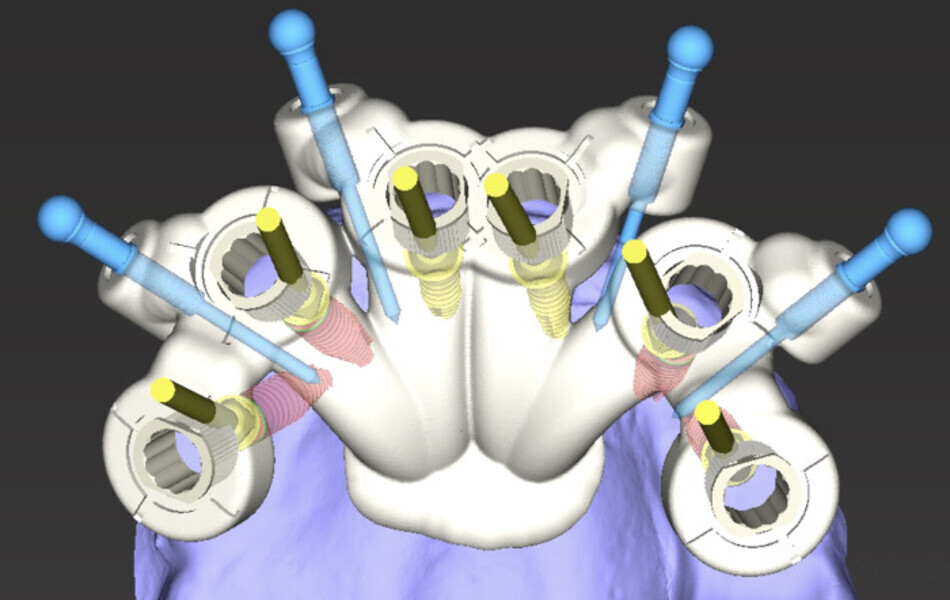 Fig. 9a: Implant surgical guide design ...