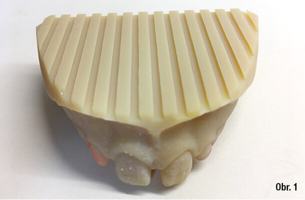 Tištěné modely pro zhotovení Klammtova aparátu