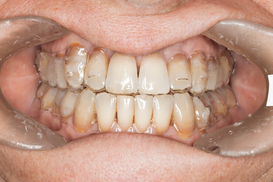 Fig. 42: Final stage of Reveal aligners. Aligner #37.