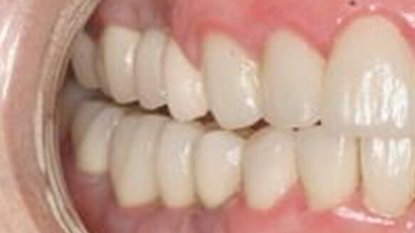 Soft-tissue collar around implants: A periodontal compromise or not?