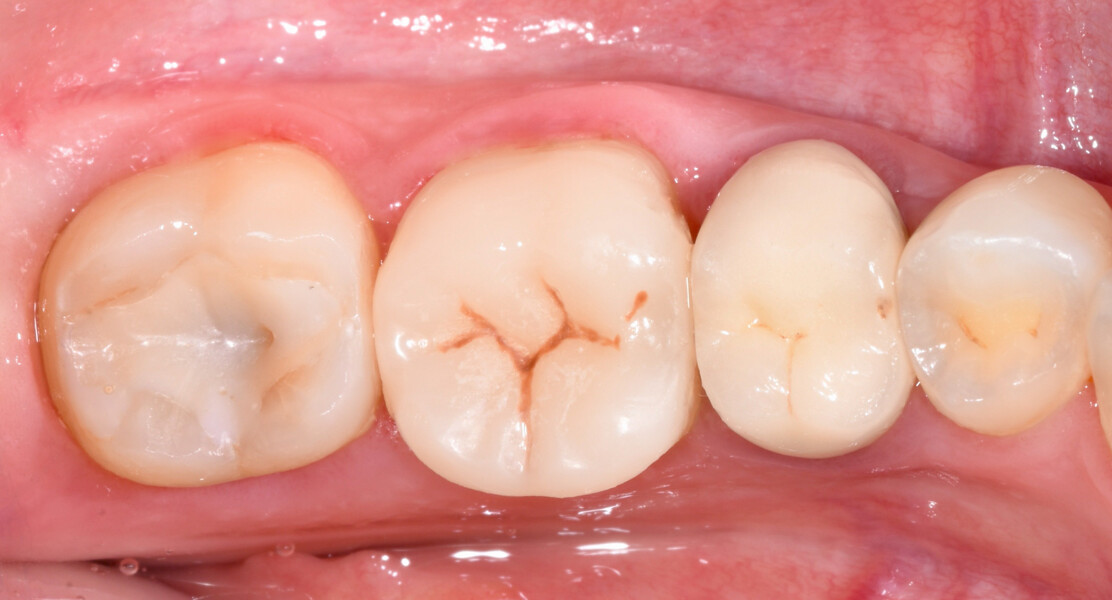 Fig. 12: Clinical occlusal view of the luted endocrown on tooth #46 after removal of the dental dam.