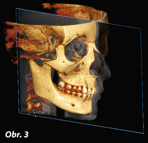 Anteriorní pohled na 3D rekonstrukci