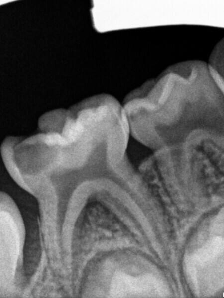 Fig. 2 : Lésion cavitaire profonde et perte osseuse dans la zone de la furcation.