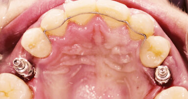 Implantace pomocí dynamické navigace s okamžitým zatížením