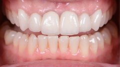 A bright new smile with KATANA Zirconia YML
