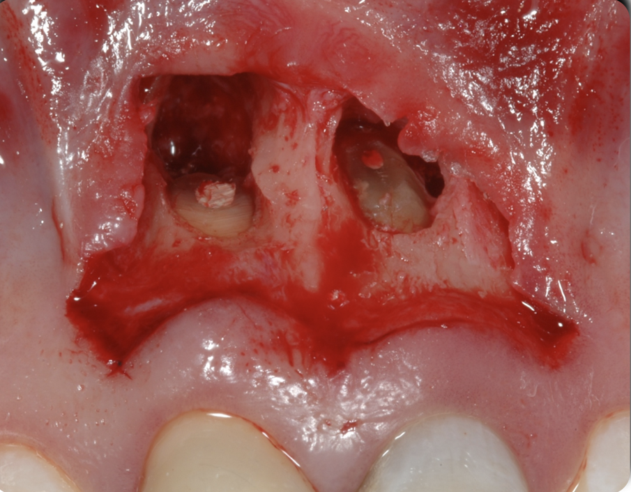 Figg. 9-11 - Fasi dell’apicectomia eseguita in attesa della completa maturazione dei tessuti parodontali.