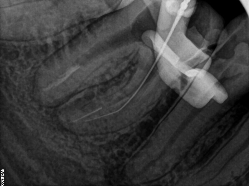 Fig. 20: Intra-op radiograph confirming lack of bypass and of patency.