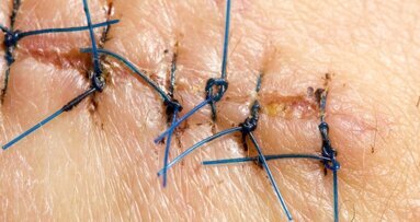 Nici chirurgiczne z czujnikami ułatwią gojenie ran po operacjach