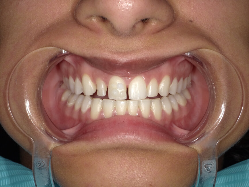 Fig 10: Direct placement technique for shade selection