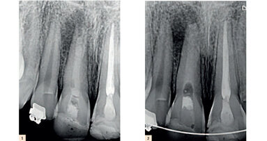 Traitement d’une incisive centrale non vitale avec un apex ouvert, en utilisant un matériel de réparation novateur à base de MTA