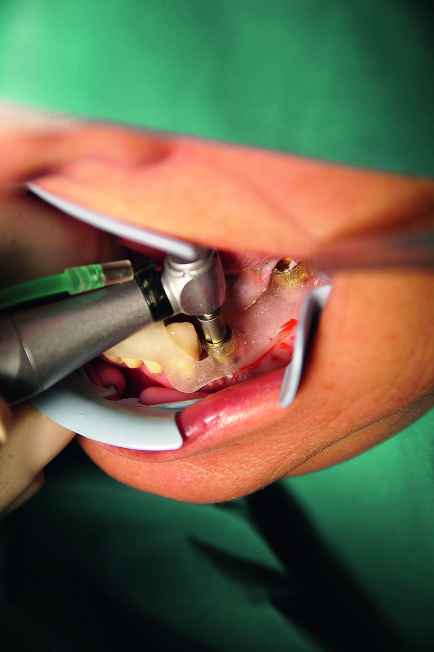 Fig. 8 : Forage guidé à travers le manchon de forage selon le protocole chirurgical.