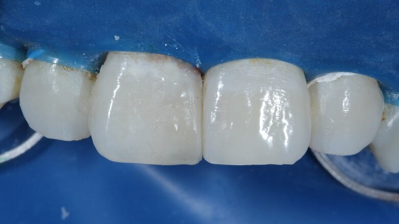 Fig 17: Enamel layer