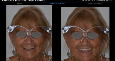 Sviluppo di un progetto interamente digitale dedicato alla protesi totale