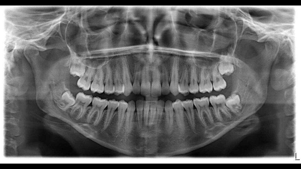 Trattamento di un paziente adulto con affollamento lieve-moderato mediante NOXI