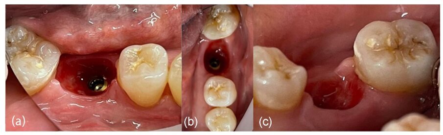Fig. 26_Generazione del profilo cervicale a 4 mesi dopo la rimozione del moncone personalizzato: a) vista vestibolare, b) vista occlusale, c) vista linguale.