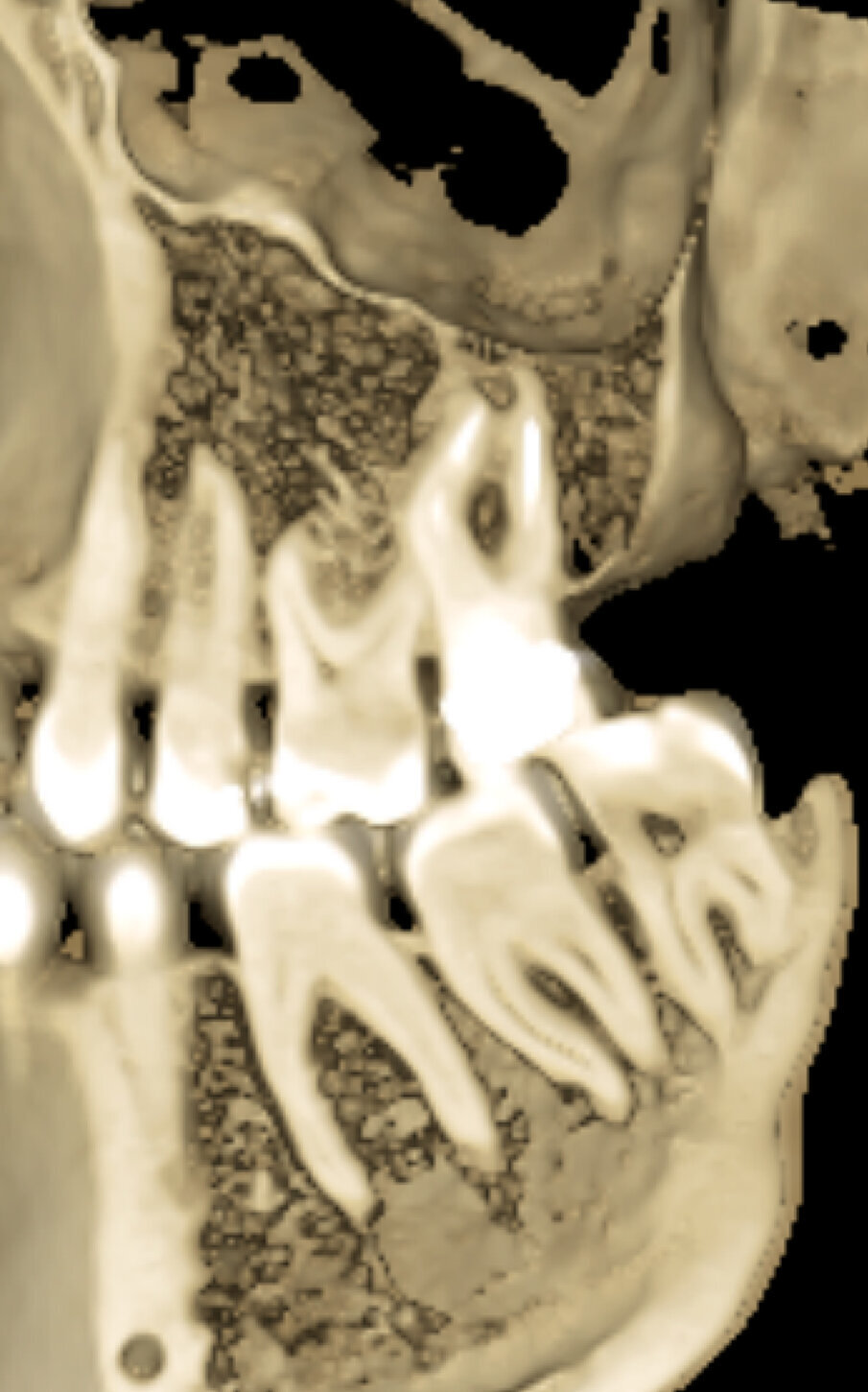 Fig. 2b - Una piccola lesione è evidente all’apice della radice mesiovestibolare.