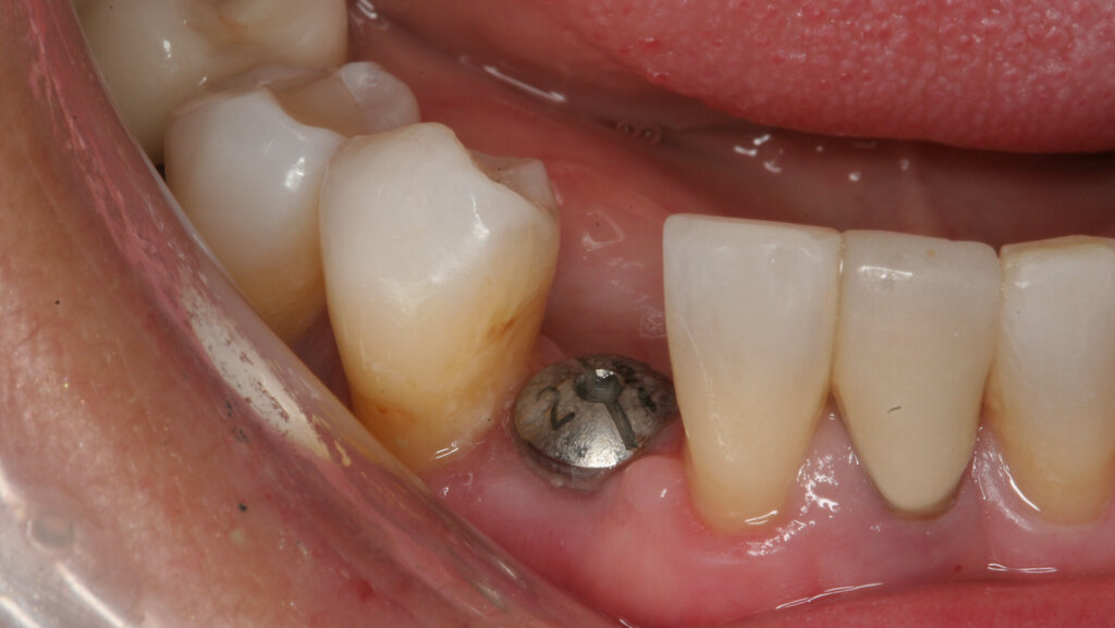 Ημερίδα του ΟΣΑ για τα εμφυτεύματα