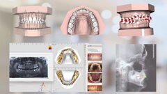 CBCT-based crown–root set-up supports anatomy-guided orthodontic planning
