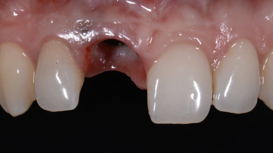 Fig. 29_Aspetto dei tessuti condizionati dopo la rimozione del provvisorio.