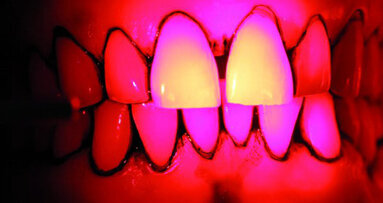 Parodontites et traitements laser