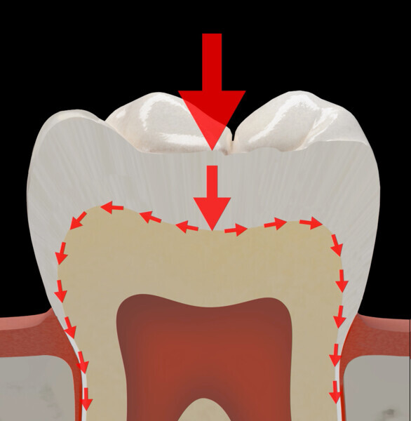 Fig. 39a: Schematic representation of the stress distribution in a typical tooth crown (a) and in a crown restoration of a molar without a fibre-reinforced membrane (b) and with a fibre-reinforced membrane (c).