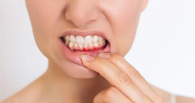 Secondo uno studio la parodontite aumenta il rischio di ictus nei giovani