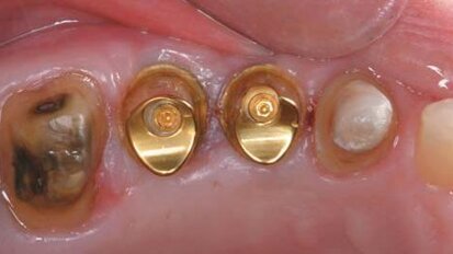 Leczenie odcinka bocznego szczęki z zastosowaniem Encode® Complete Restorative System