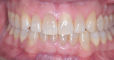 Nivellement adéquat de la courbe de Spee – Un facteur essentiel du traitement de la supraclusion par aligneurs