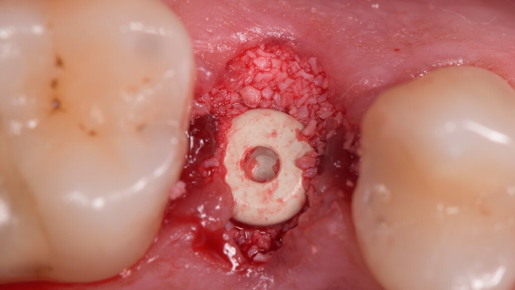 Impianto bifasico in Zirconia – Globale Restauro Metal-Free