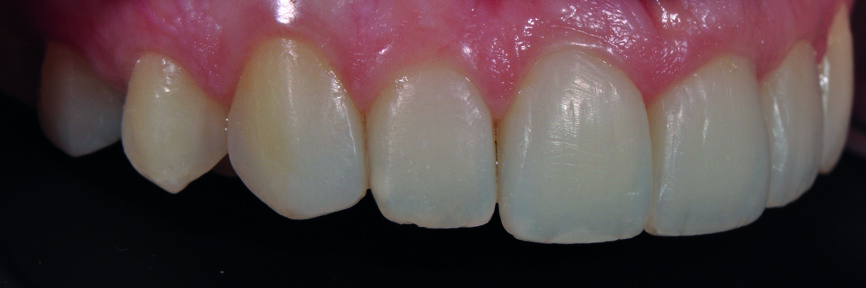 Fig 6 b) : vue intraorale latérale. 