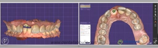 Intraoralni sken sa Medit i.o skenerom