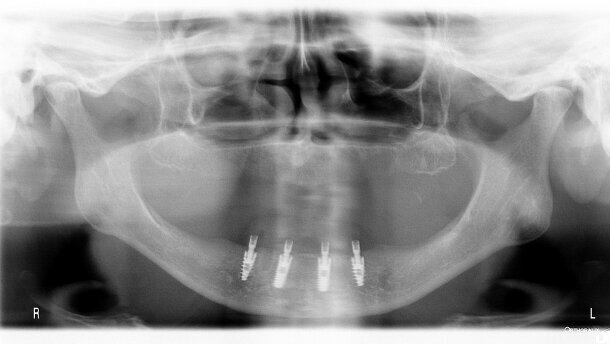 Analiza porównawcza występowania periimplantitis – kliniczne obserwacje 4-letnie
