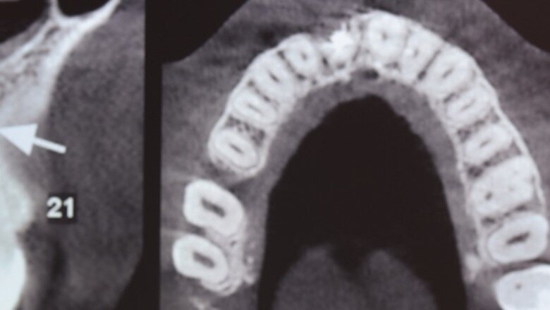 Figuras 2 y 3. Imágenes de tomografía CBCT donde se observa el grado de destrucción de la pared vestibular.