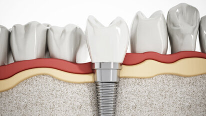 Immunreaktion bei Implantaten vermeiden Immunreaktion bei Implantaten vermeiden