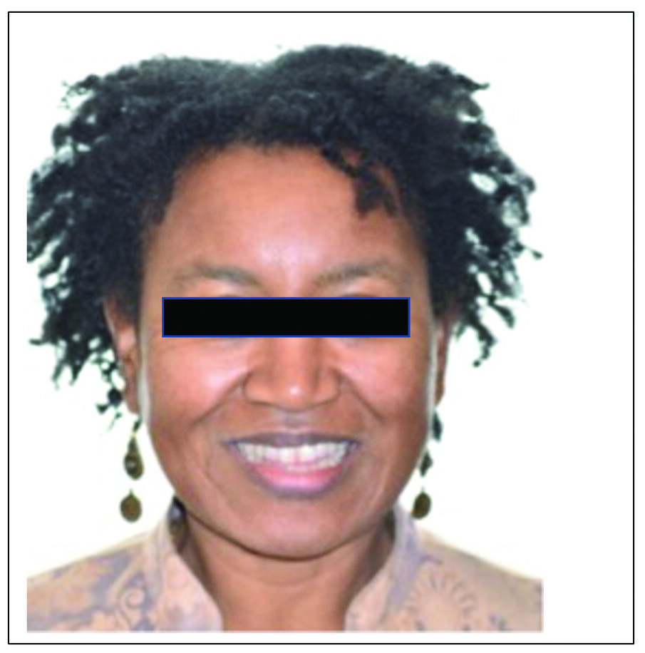 Fig. 13a. Patient S. P. pre-treatment.