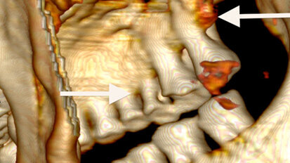 Eismumie Ötzi auf den Zahn gefühlt Eismumie Ötzi auf den Zahn gefühlt