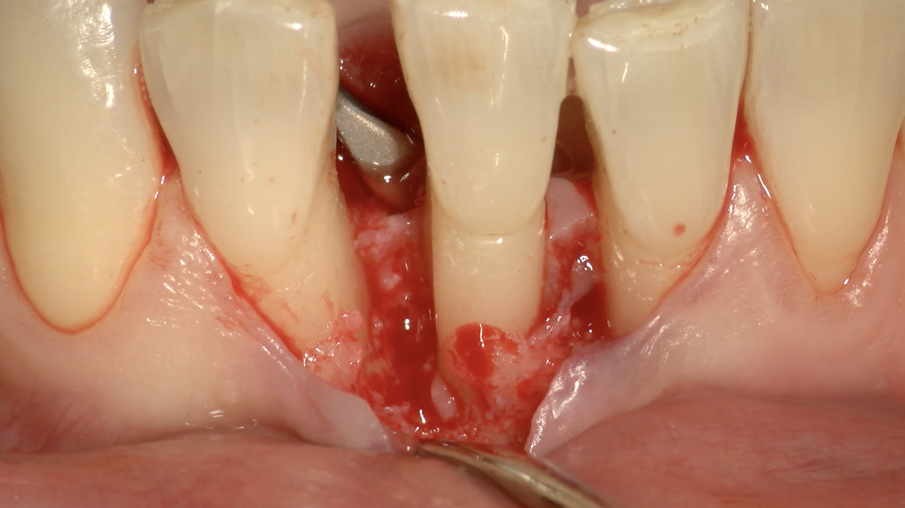 Fig. 6e - Difetto infraosseo mesiale.