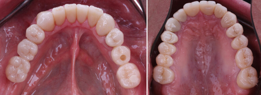 Figs 30A-B: Occlusal view of the restorations in the upper and lower jaw