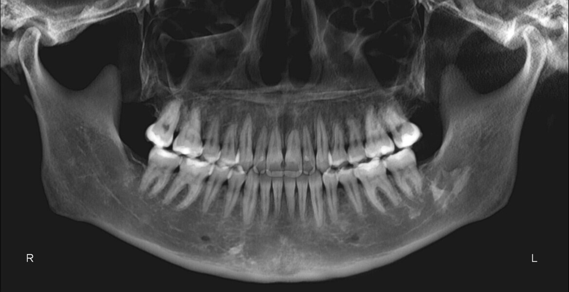 Fig. 14: Post-treatment panoramic radiograph.