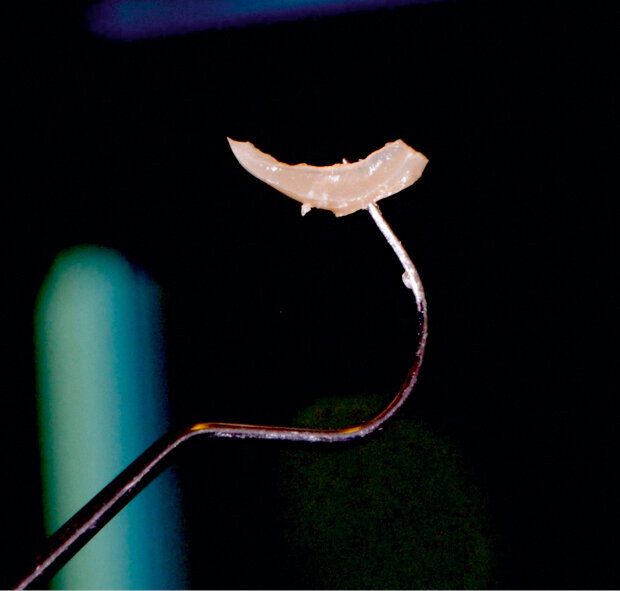 Fig. 9: Excess removal is easily achieved owing to the new technology based on the Ivocerin photoinitiator.