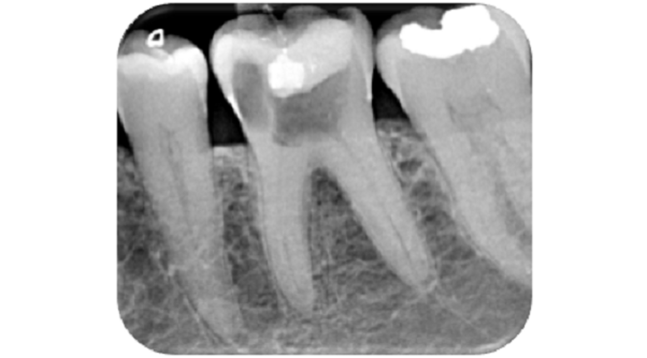 Fig. 1: Pre-op radiograph.