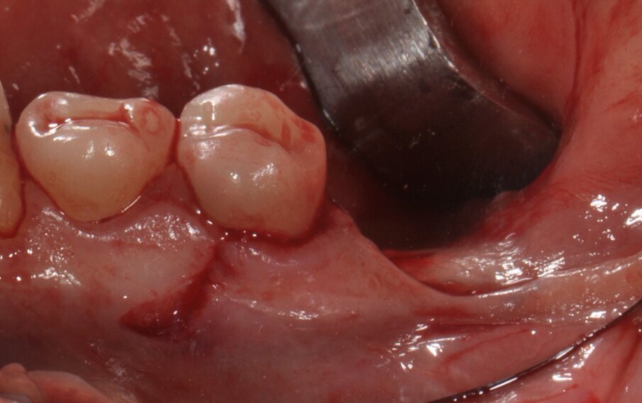 Figg. 3, 4_Come previsto dalla procedura di GBR Pocket Technique, si esegue un’incisione minimamente invasiva con estensione vestibolare e linguale.