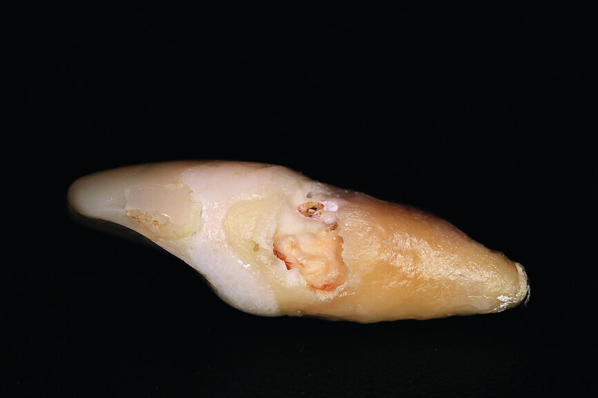 Fig. 8: The resorption of tooth #21, external view. This confirmed the accuracy of the diagnosis from
the imaging procedure.